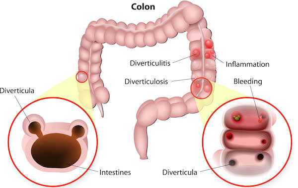 Diverticulitis Diverticulitis